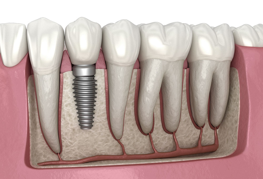 Emerging Trends in Dental Implant Materials for Enhanced Durability
