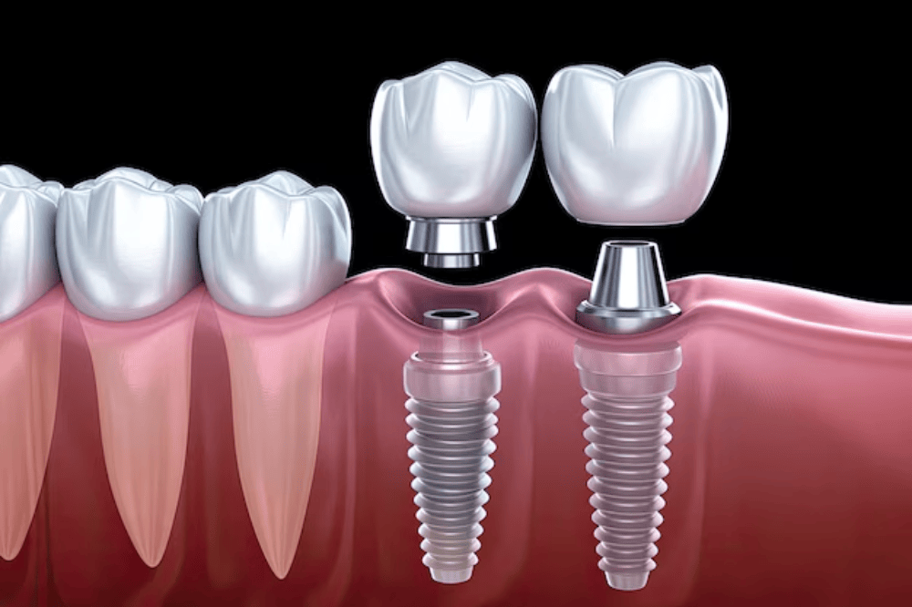 Exploring the Impact of Stress on Dental Implant Success